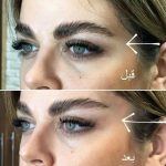 خرید کش لیفت ابرو و شقیقه